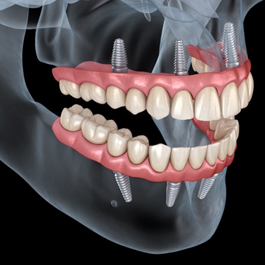 an illustration of All-On-4 implants in Brick Township