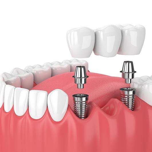 Diagram of an implant-retained dental bridge in Brick Township