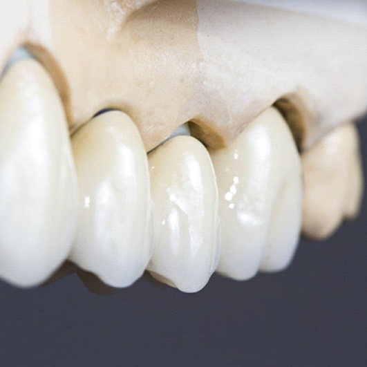 Dental bridge attached to a dental model