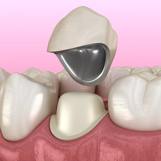 Diagram showing how dental crowns in Brick Township work