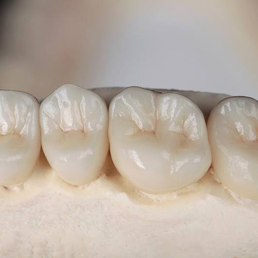 Series of dental crowns in Brick Township sitting in mold