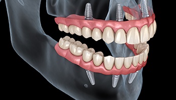 Diagram of an implant denture in Brick Township