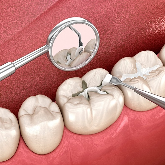 A 3D illustration of tooth-colored fillings