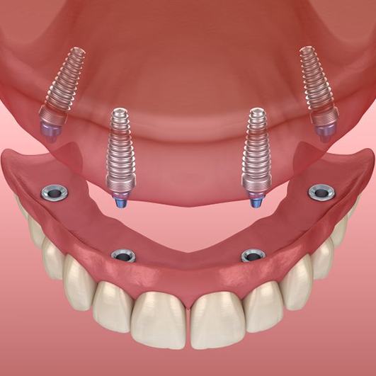 Illustration of implant dentures in Brick Township for lower arch