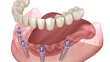 Dentist explaining process for implant dentures in Brick Township