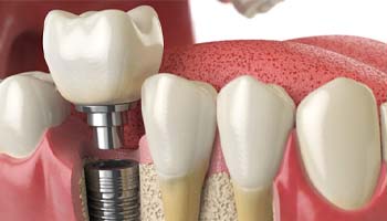 Diagram showing how dental implants integrate with bone tissue