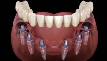 Digital diagram of implant dentures in Brick Township