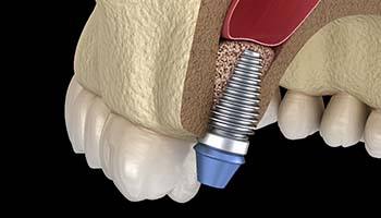 Digital diagram of a sinus lift in Brick Township for dental implants