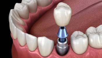 Digital diagram of a single tooth dental implant in Brick Township