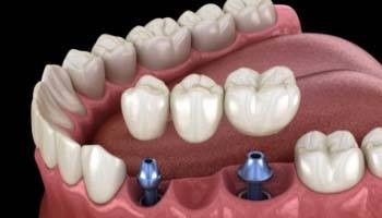 Digital diagram of an implant bridge replacing several missing teeth in Brick Township