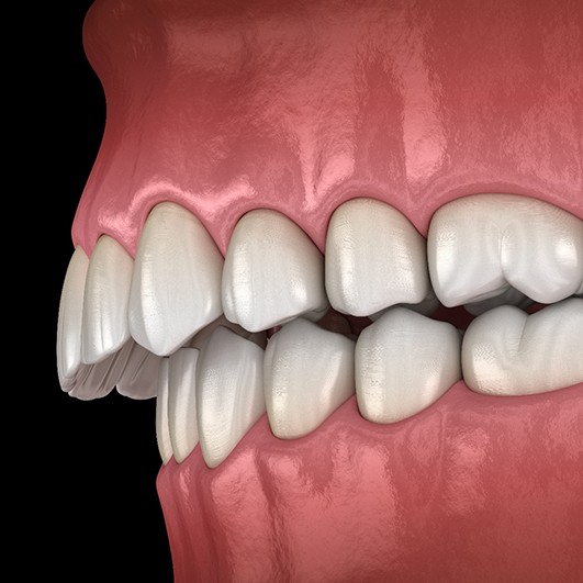 Digital illustration of overbite