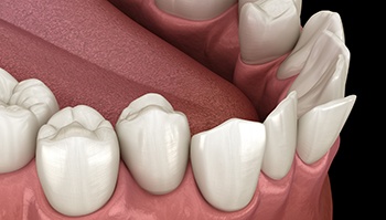 Illustration of crooked teeth