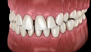 Illustration of gapped teeth