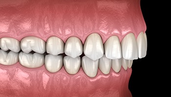 Illustration of an overbite