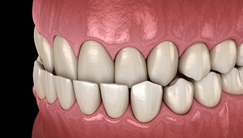 Illustration of an underbite