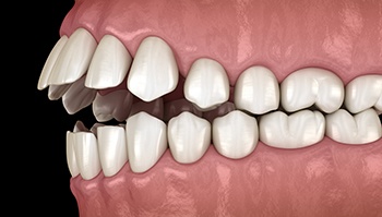 Illustration of an open bite