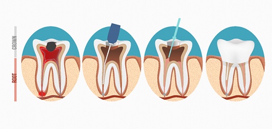 illustration for root canal therapy in Brick Township
