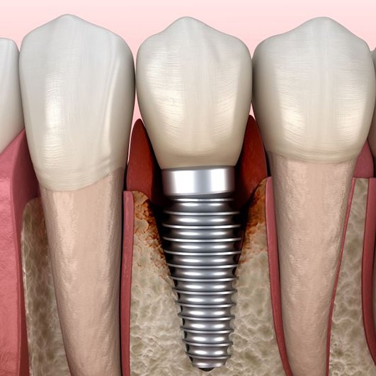 Illustration of peri-implantitis infection