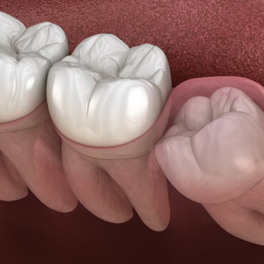 Render of wisdom tooth in Barnegat, NJ trapped under the gum