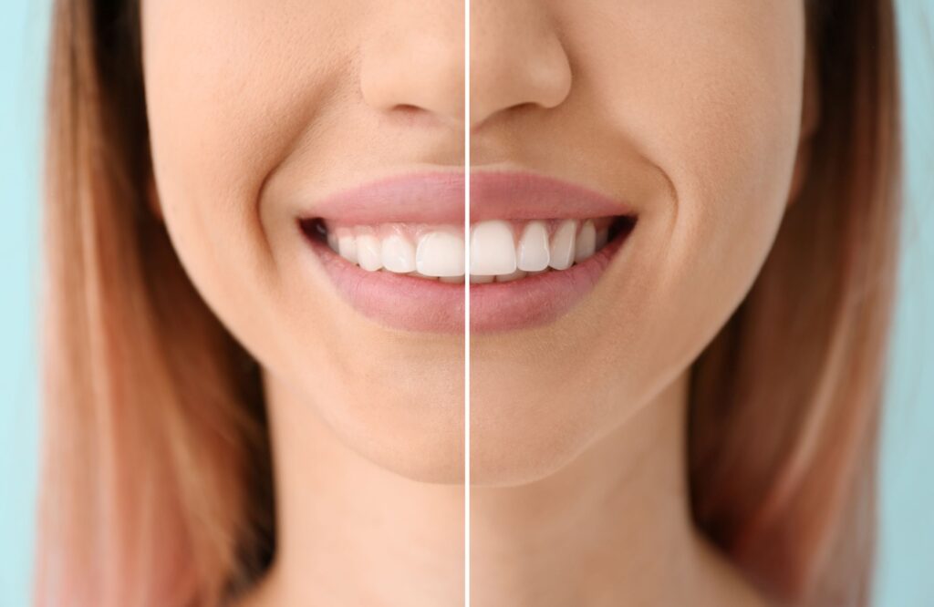 Nose-to-neck view of woman's smile that's halved to show gum recontouring results