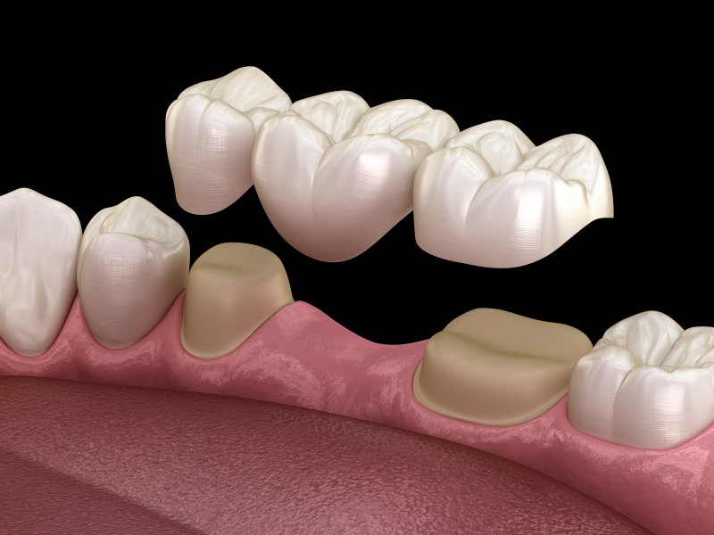 digital image of a dental bridge